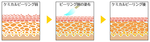 グリコール 酸 ピーリング