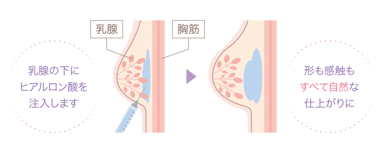 注入方法イラスト