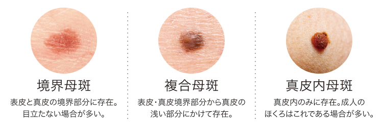 ほくろの種類