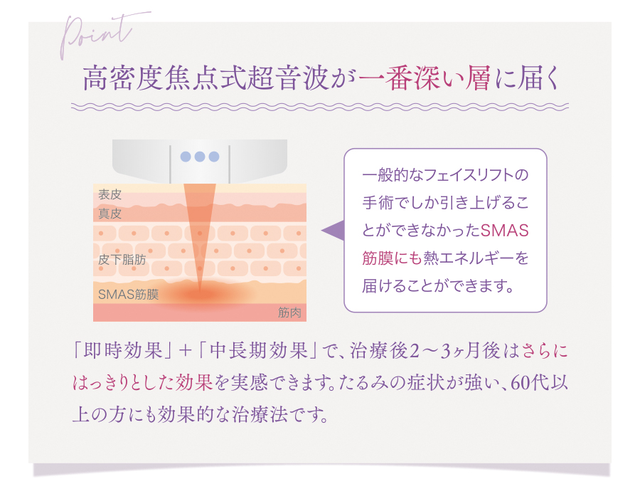 ウルセラ_ポイント