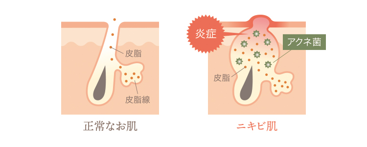 ニキビの原因