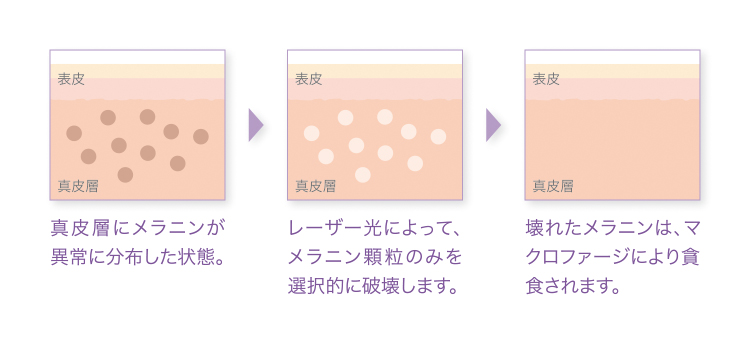 レーザートーニング肌の図