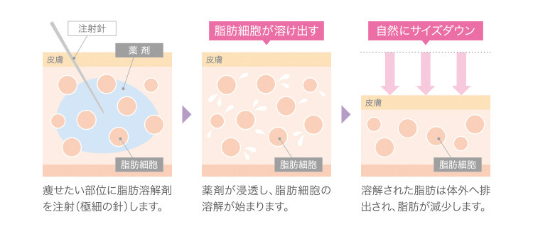 脂肪溶解注射の説明図