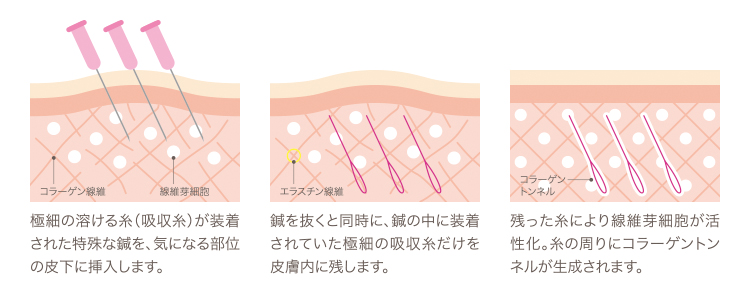 施術イラスト