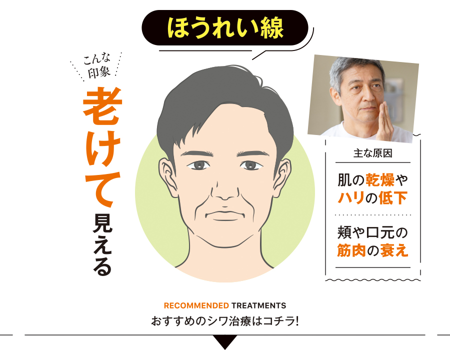 イラスト_ほうれい線